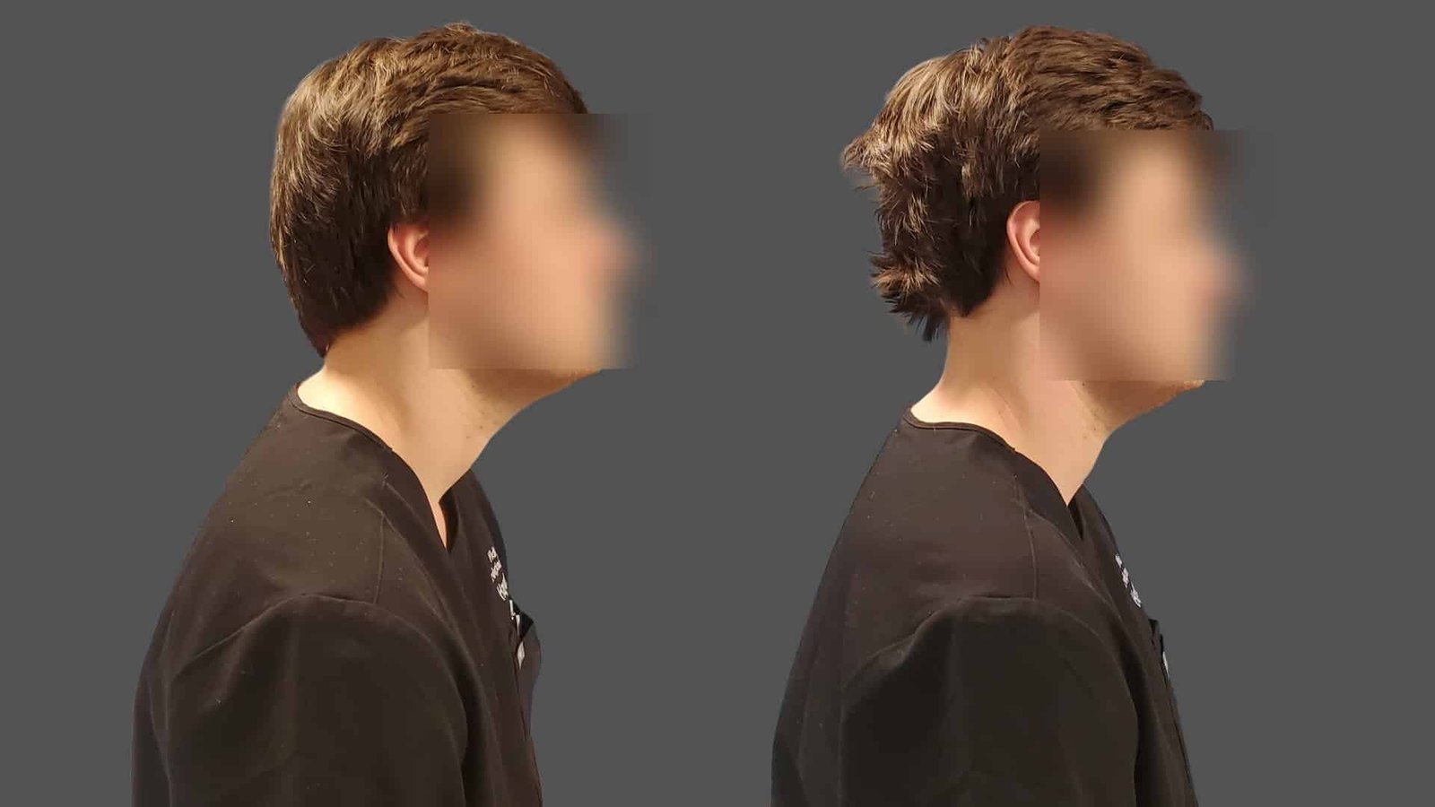 before and after image showing the effectiveness of Doc Blackstone's Structural Alignment