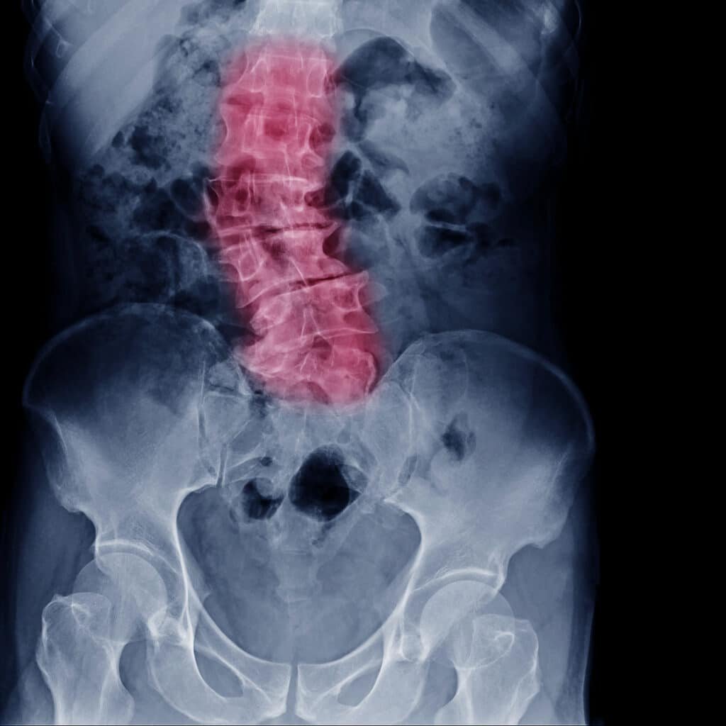 Patient spine prior to surgical intervention therapy