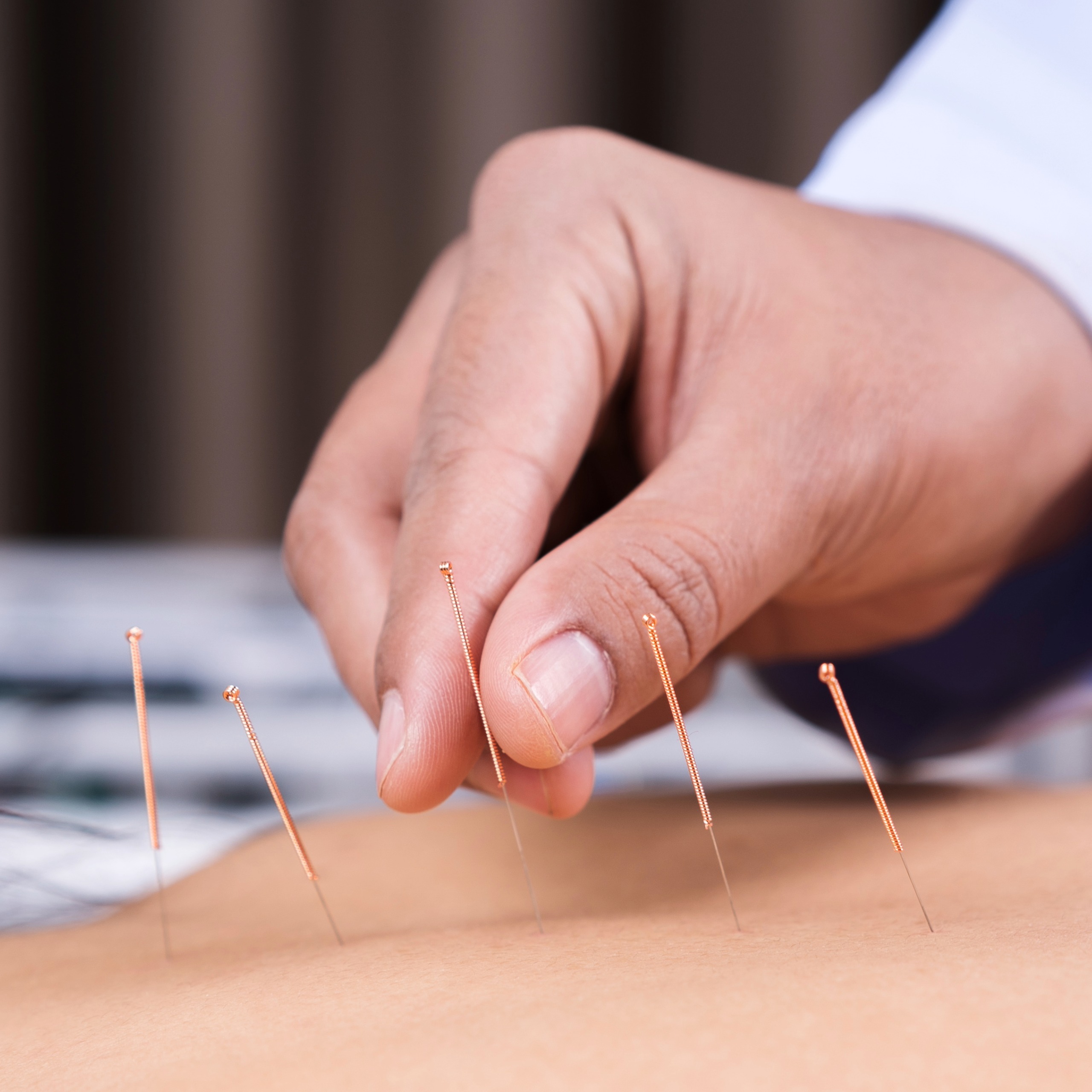 Close-up of acupuncturist needling a patient